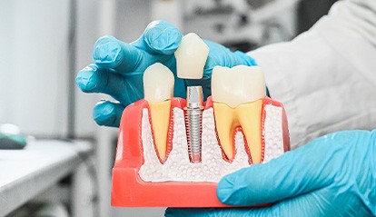 A dentist wearing sterile gloves holds an anatomical model with dental implants
