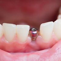 A closeup of a single tooth implant’s abutment