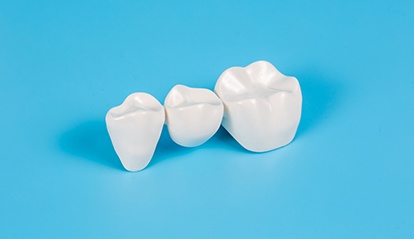 A dental bridge is a prosthetic designed to replace up to four consecutive missing teeth