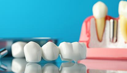 A dental bridge is a prosthetic series of teeth
