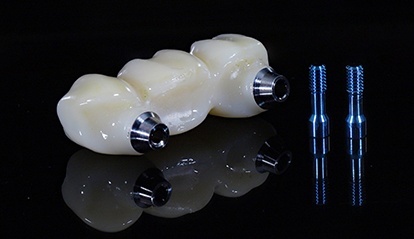 Traditional dental bridges anchor to two healthy abutment teeth