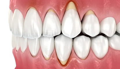 Illustration of receding gums