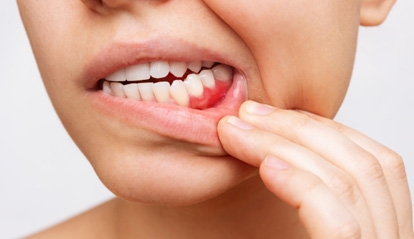Closeup of patient with red gums