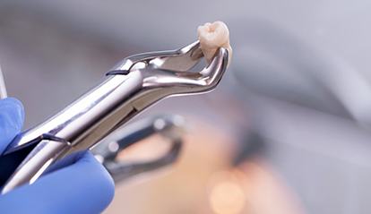 extracted tooth held with dental instrument 