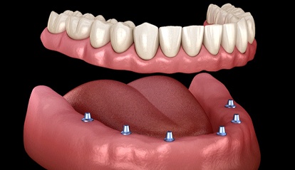 implant denture in St. Albans being placed on the lower arch