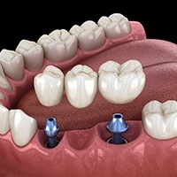 Animation of implant supported bridge