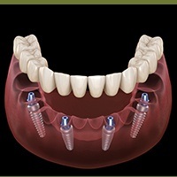 Animation of implant supported denture