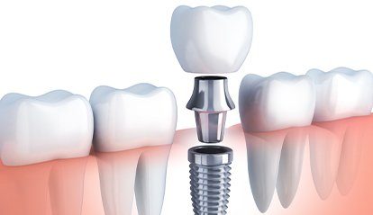 Animation of implant supported dental crowns