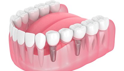 Dental implants