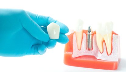 Dental implant model