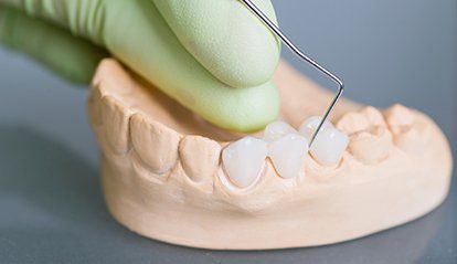 Model smile with fixed bridge restoration