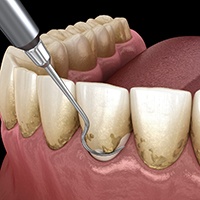 A scaling and root planing treatment