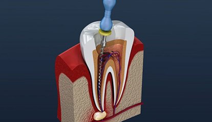 diagram of tooth getting root canal in St. Albans 