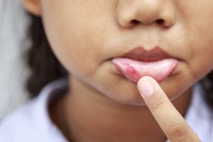 a child with a canker sore on their lip