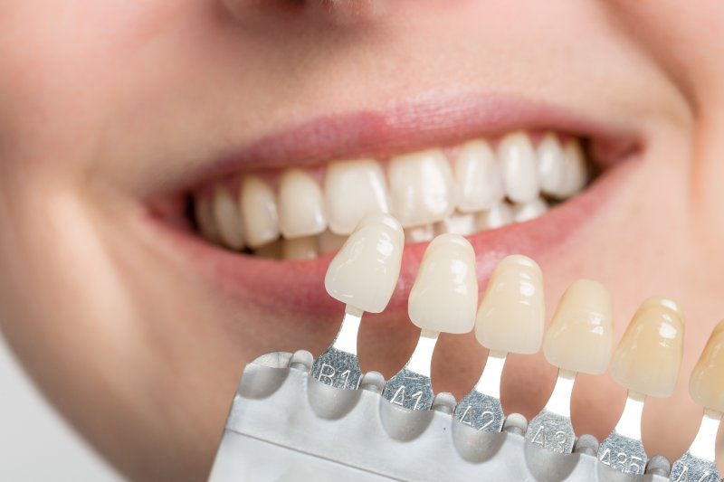 a dentist in St. Albans using a shade guide when determining the color of veneers