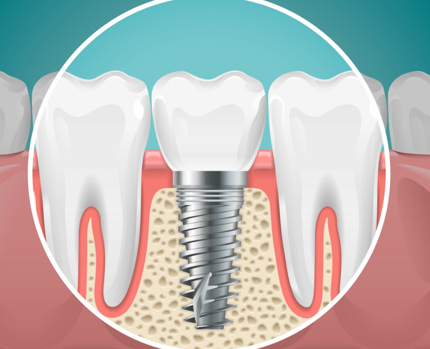 Dental implant illustration