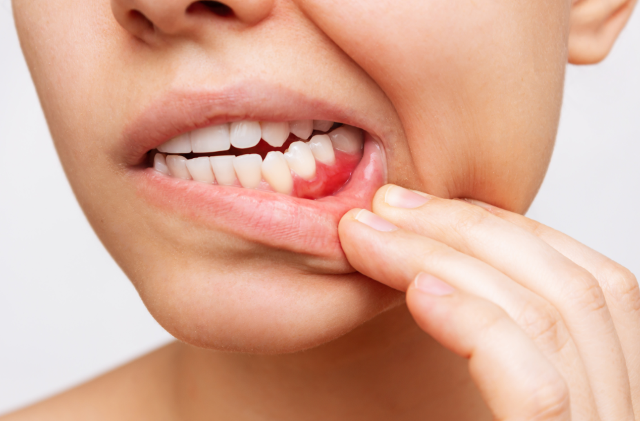 Woman showing inflamed gums